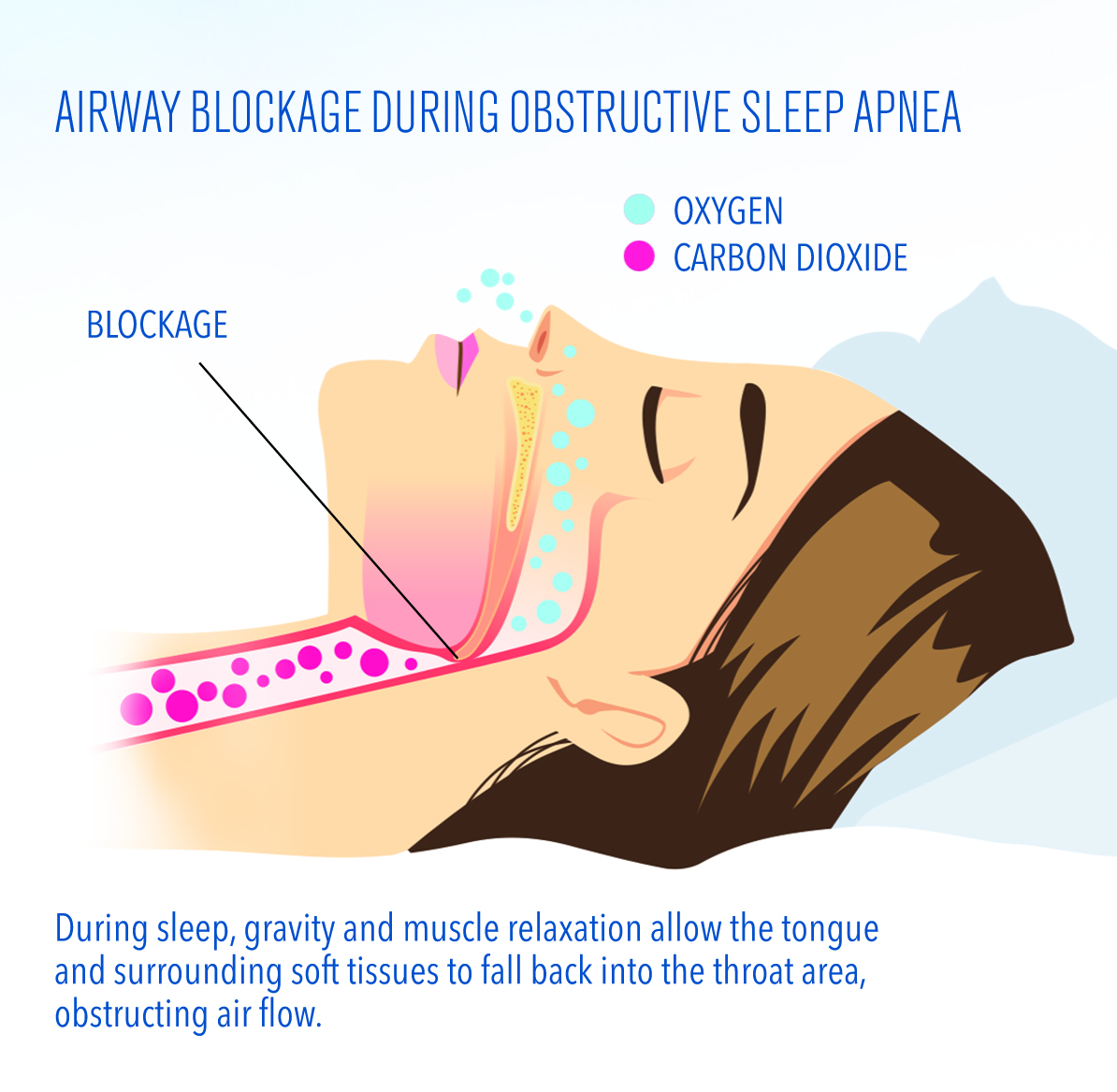 more-than-a-snore-addressing-sleep-apnea-at-st-clair-hospital-st