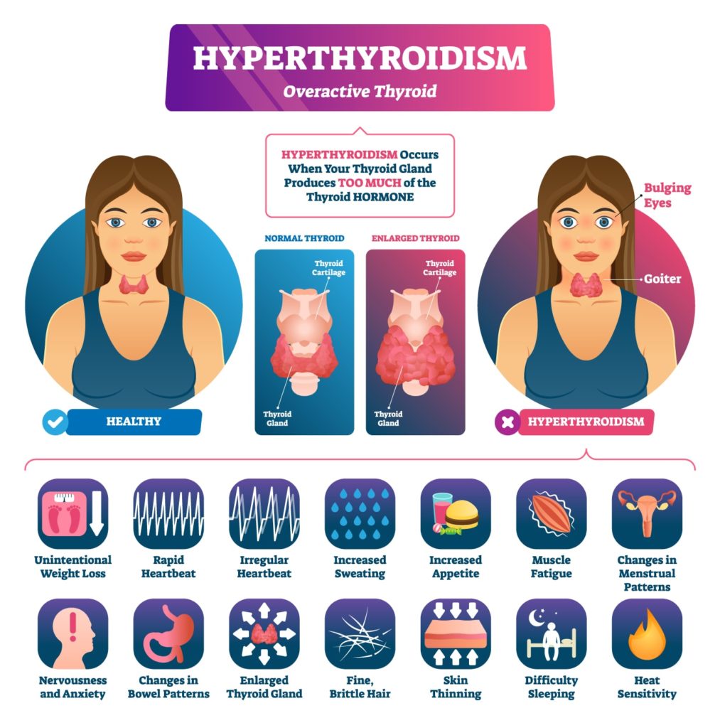 Overactive Thyroid Pictures