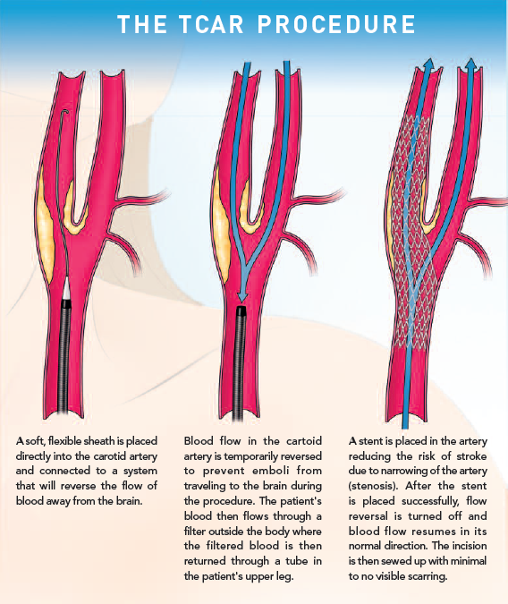 transcarotid-artery-revascularization-st-clair-health